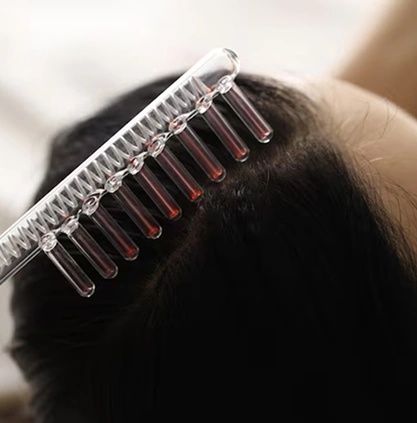 Dandruff treatment in Coimbatore Dandruff treatment in Coimbatore