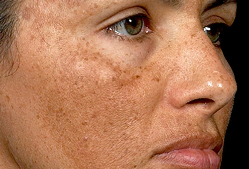 Advanced pigmentation treatment in Coimbatore for reducing dark spots, melasma, and uneven skin tone.