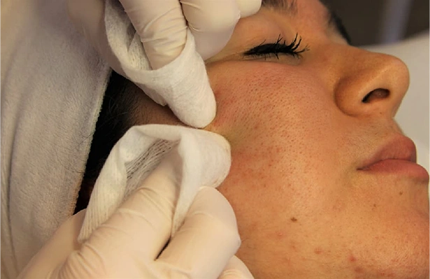 Facial in Coimbatore Facial in Coimbatore